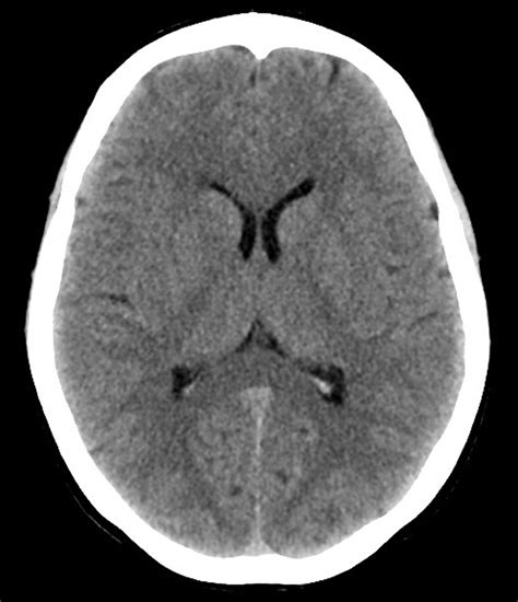 the villages brain ct scan